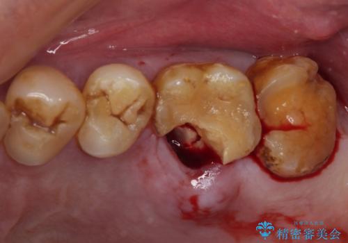 食事で割れてしまった奥歯 外科処置を用いた補綴治療の治療後