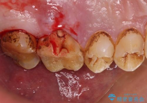 食事で割れてしまった奥歯 外科処置を用いた補綴治療の治療中
