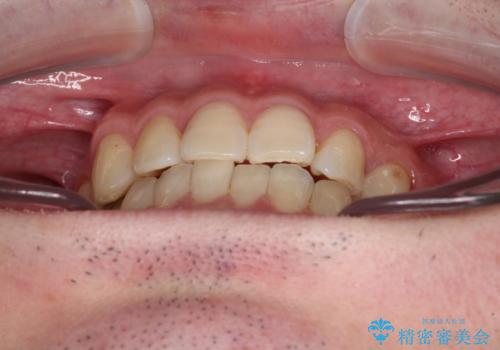 欠損のある歯列　インビザラインで整った歯並びにの治療後