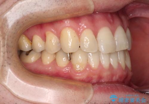 欠損のある歯列　インビザラインで整った歯並びにの治療後