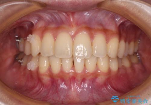 【モニター】インビザラインをしっかり使って短期間矯正治療の治療中