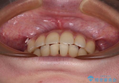 【モニター】インビザラインをしっかり使って短期間矯正治療の治療中