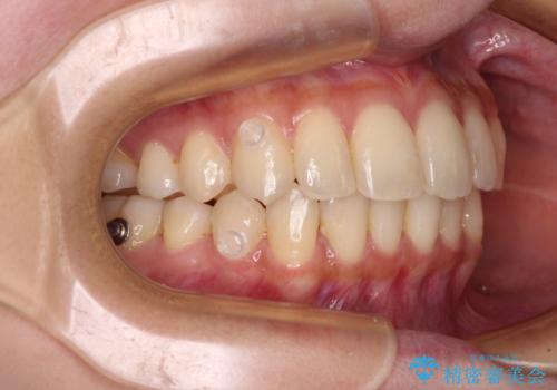 【モニター】インビザラインをしっかり使って短期間矯正治療の治療中