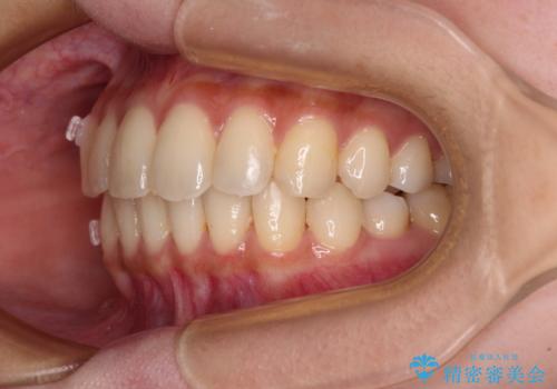 【モニター】インビザラインをしっかり使って短期間矯正治療の治療中