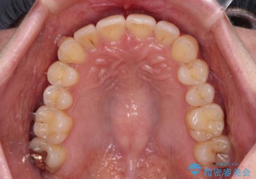【モニター】インビザラインをしっかり使って短期間矯正治療の治療中