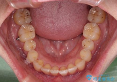 【モニター】インビザラインをしっかり使って短期間矯正治療の治療中