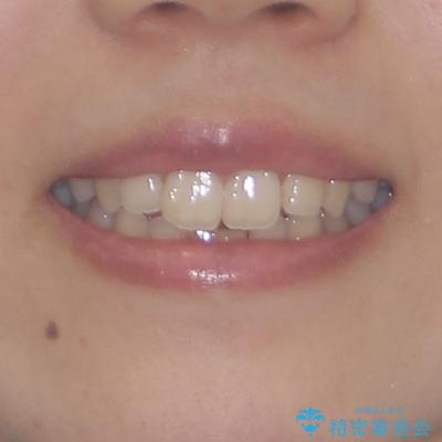 乳歯残存と欠損の前歯　矯正治療とオールセラミックブリッジ治療の治療前（顔貌）