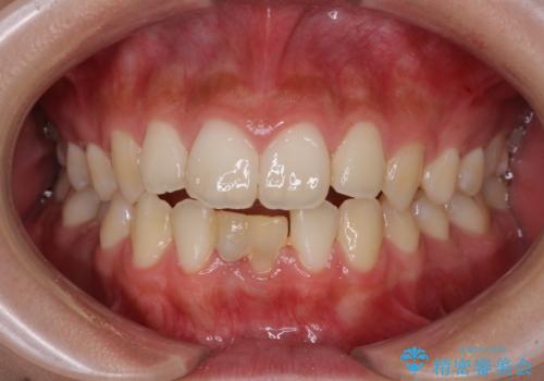 乳歯残存と欠損の前歯 矯正治療とオールセラミックブリッジ治療の症例 治療前