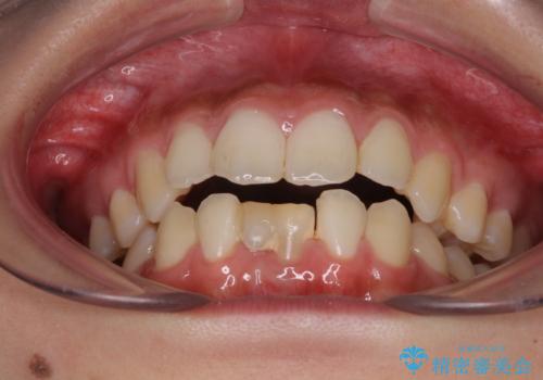 乳歯残存と欠損の前歯 矯正治療とオールセラミックブリッジ治療の治療前