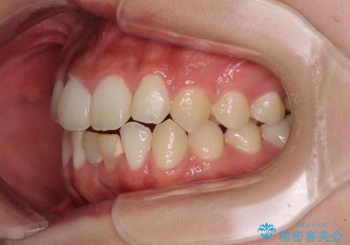 乳歯残存と欠損の前歯　矯正治療とオールセラミックブリッジ治療の治療前