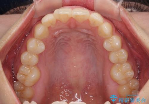 乳歯残存と欠損の前歯 矯正治療とオールセラミックブリッジ治療の治療前