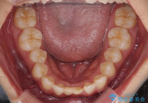 乳歯残存と欠損の前歯 矯正治療とオールセラミックブリッジ治療の治療前