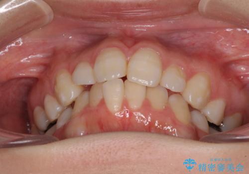 抜歯矯正の後戻り インビザライン・ライトによる矯正治療の治療前
