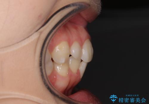 抜歯矯正の後戻り インビザライン・ライトによる矯正治療の治療前