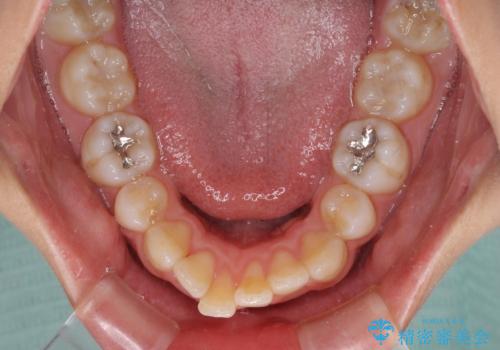 抜歯矯正の後戻り インビザライン・ライトによる矯正治療の治療前