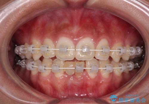乳歯残存と欠損の前歯　矯正治療とオールセラミックブリッジ治療の治療中