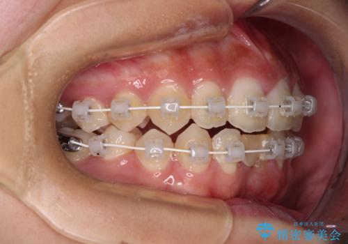 乳歯残存と欠損の前歯 矯正治療とオールセラミックブリッジ治療の治療中