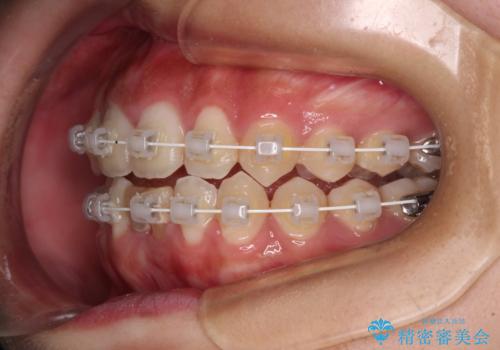 乳歯残存と欠損の前歯 矯正治療とオールセラミックブリッジ治療の治療中