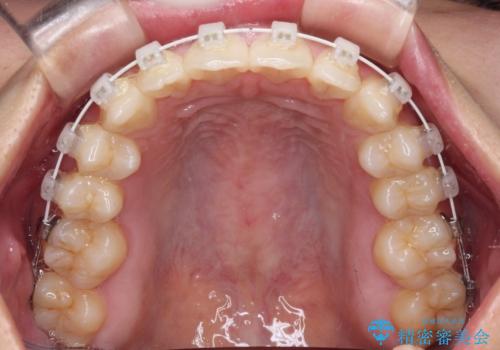 乳歯残存と欠損の前歯　矯正治療とオールセラミックブリッジ治療の治療中