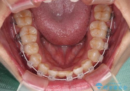 乳歯残存と欠損の前歯 矯正治療とオールセラミックブリッジ治療の治療中