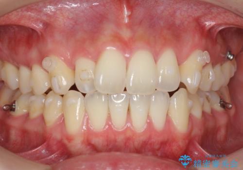 前歯のねじれを改善　マウスピース矯正インビザラインの治療中
