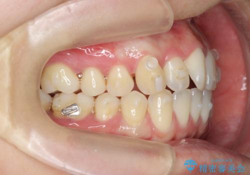 前歯のねじれを改善 マウスピース矯正インビザラインの治療中