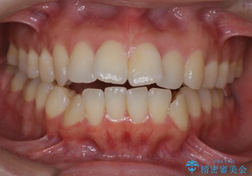 【審美ワイヤー装置】前歯を噛ませたいの症例 治療前