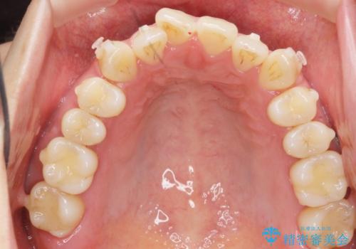 前歯のねじれを改善 マウスピース矯正インビザラインの治療中
