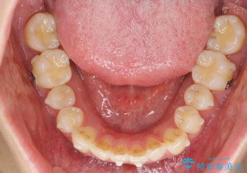 前歯のねじれを改善 マウスピース矯正インビザラインの治療中