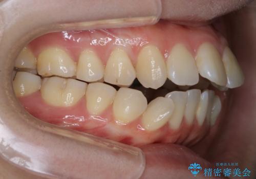 【審美ワイヤー装置】前歯を噛ませたいの治療前