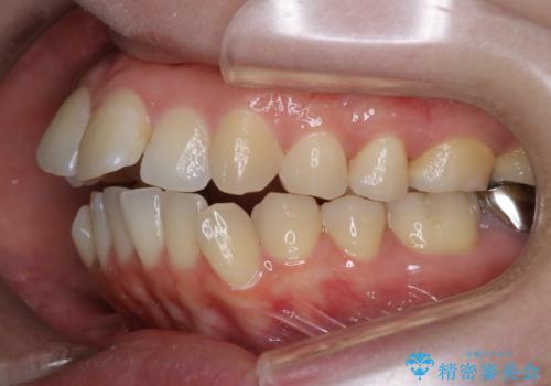 【審美ワイヤー装置】前歯を噛ませたいの治療前