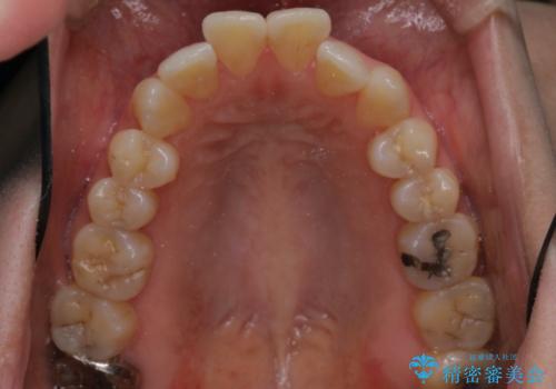 【審美ワイヤー装置】前歯を噛ませたいの治療前