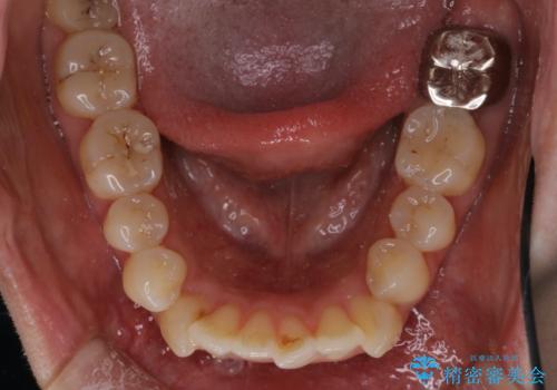 【審美ワイヤー装置】前歯を噛ませたいの治療前