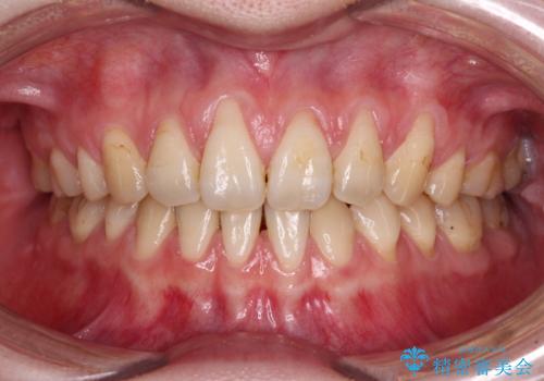 矯正治療で退縮してしまった歯肉　歯肉移植で自然な前歯にの治療前