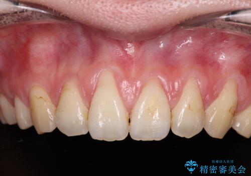 矯正治療で退縮してしまった歯肉 歯肉移植で自然な前歯にの症例 治療前