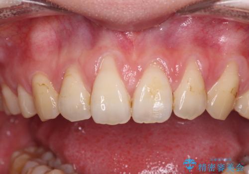 矯正治療で退縮してしまった歯肉 歯肉移植で自然な前歯にの治療前