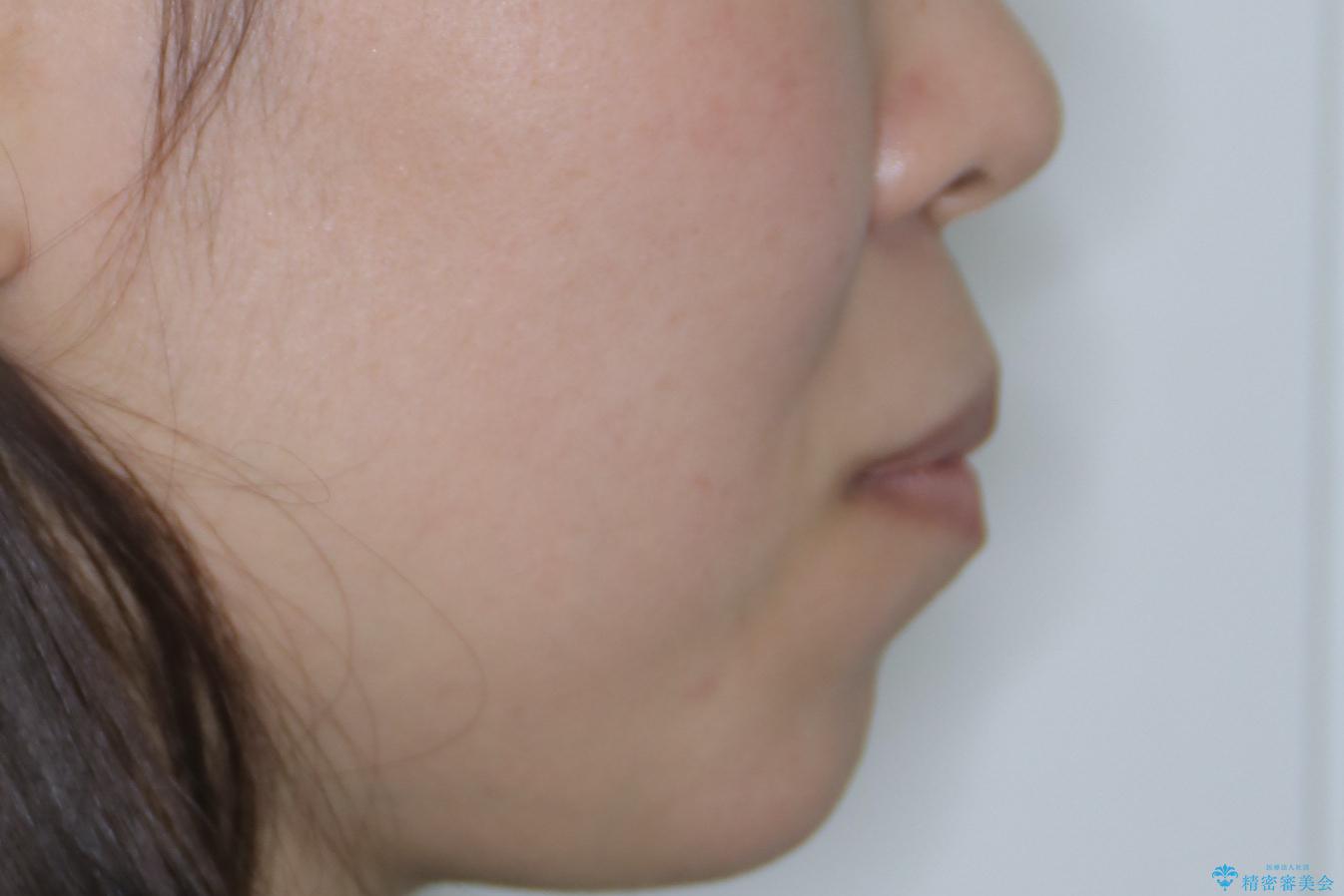 【審美ワイヤー装置】前歯を噛ませたいの治療前(顔貌)