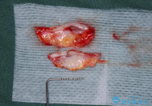 矯正治療で退縮してしまった歯肉 歯肉移植で自然な前歯にの治療中