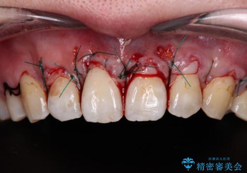 矯正治療で退縮してしまった歯肉　歯肉移植で自然な前歯にの治療中