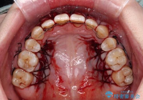 矯正治療で退縮してしまった歯肉 歯肉移植で自然な前歯にの治療中