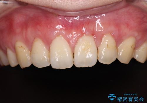 矯正治療で退縮してしまった歯肉 歯肉移植で自然な前歯にの治療中