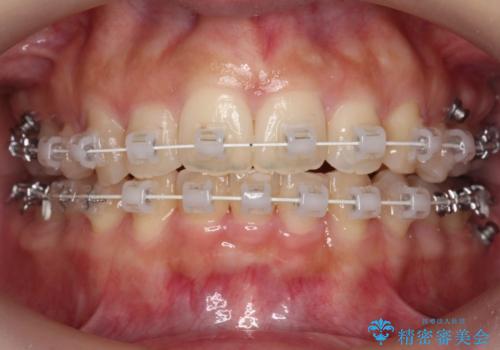 前歯がでている　最小限の抜歯で口を閉じやすくの治療中