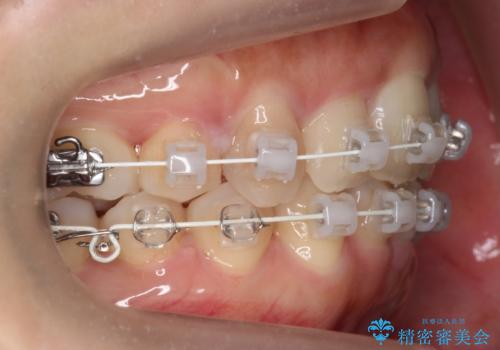 前歯がでている　最小限の抜歯で口を閉じやすくの治療中