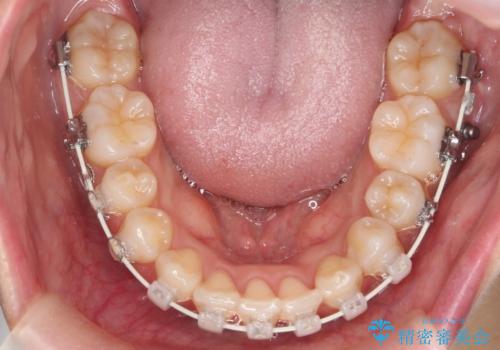 前歯がでている　最小限の抜歯で口を閉じやすくの治療中