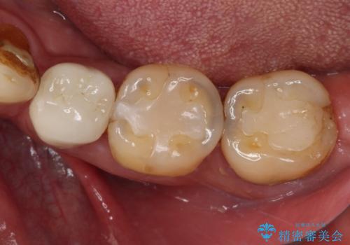 痛みの続く大きな虫歯の奥歯　オールセラミッククラウンでの補綴治療の治療前