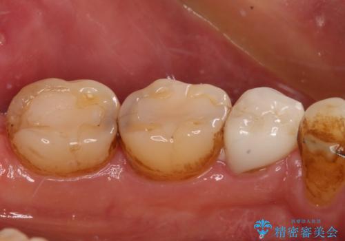 痛みの続く大きな虫歯の奥歯　オールセラミッククラウンでの補綴治療の治療前