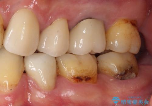 痛みの続く大きな虫歯の奥歯 オールセラミッククラウンでの補綴治療の治療前