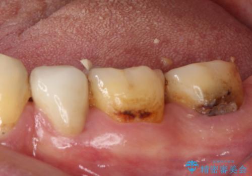 痛みの続く大きな虫歯の奥歯 オールセラミッククラウンでの補綴治療の治療前