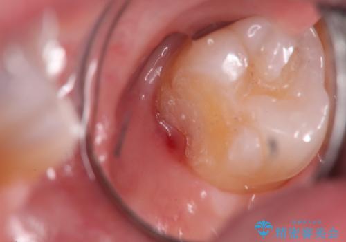 奥歯の深くて確認しにくい虫歯 ゴールドインレーでの治療の治療中
