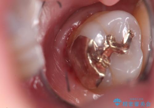 奥歯の深くて確認しにくい虫歯　ゴールドインレーでの治療の治療後